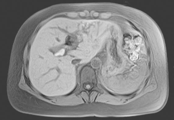 图2 MRCP（2012年7月）